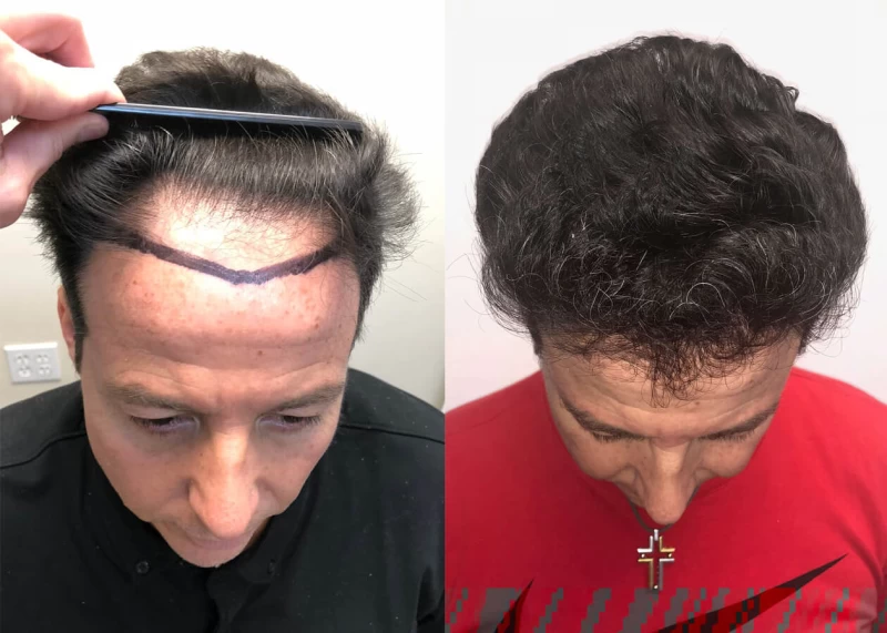 Patient p399 hair transplant before and after tilt view
