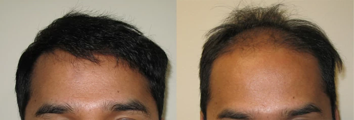 Patient 3 Hair Transplant Before and After