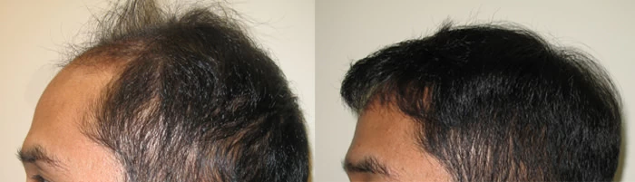 Patient p3 hair transplant before and after left view