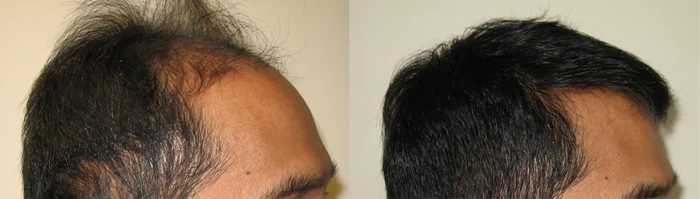 Patient p3 hair transplant before and after right view