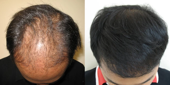 Patient p3 hair transplant before and after tilt view