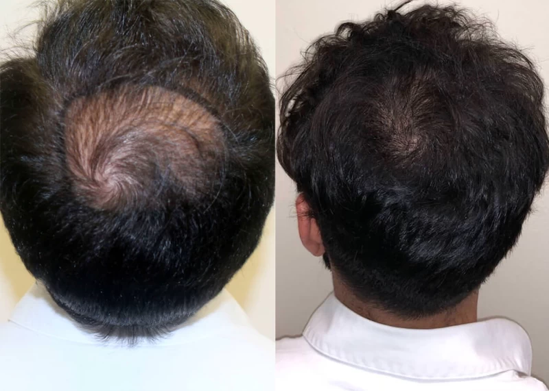 Patient p400 hair transplant before and after crown view