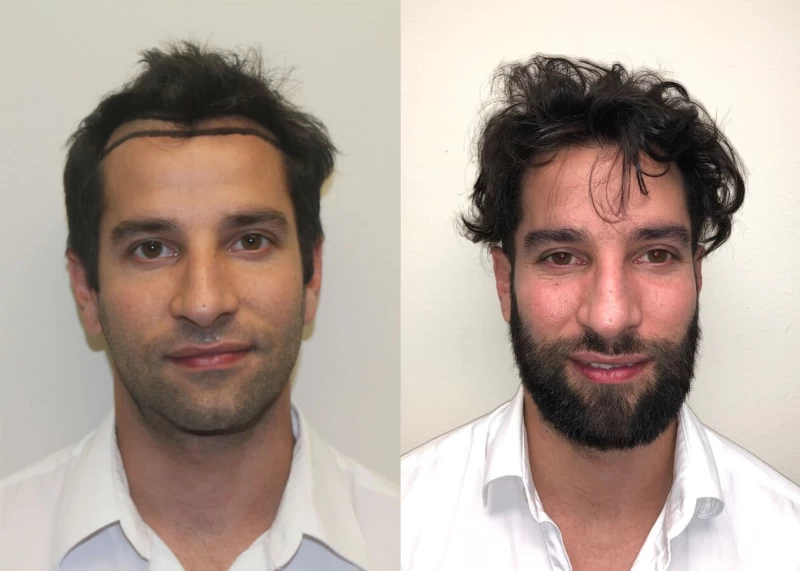 Lionel Hair Transplant Before and After