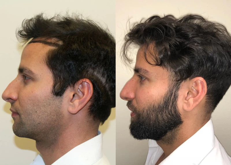 Patient p400 hair transplant before and after left view