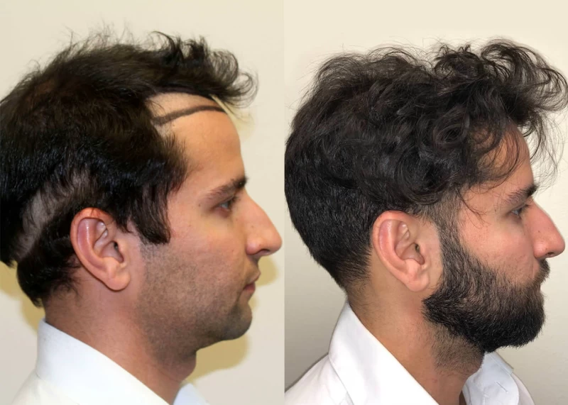 Patient p400 hair transplant before and after right view