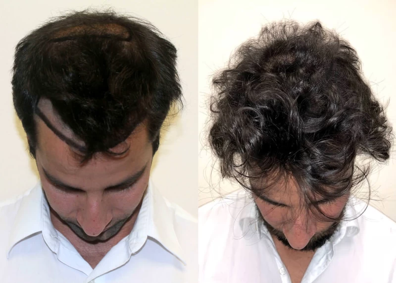 Patient p400 hair transplant before and after tilt view