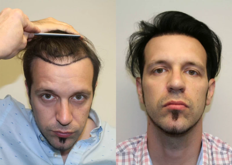 Andy Hair Transplant Before and After