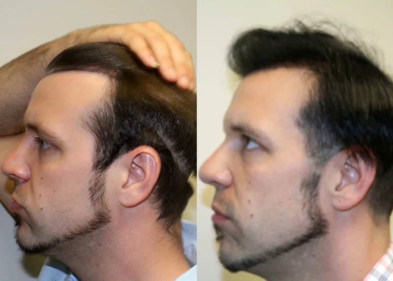 Patient p401 hair transplant before and after left view