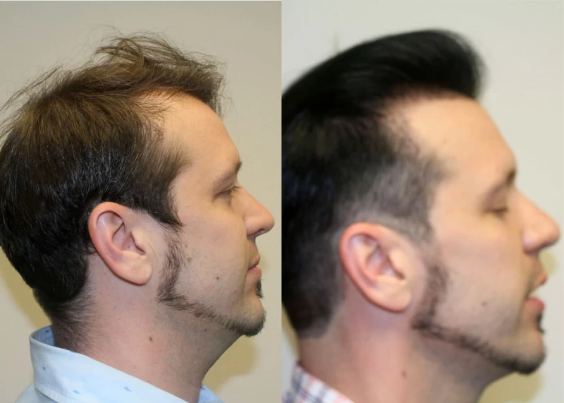 Patient p401 hair transplant before and after right view