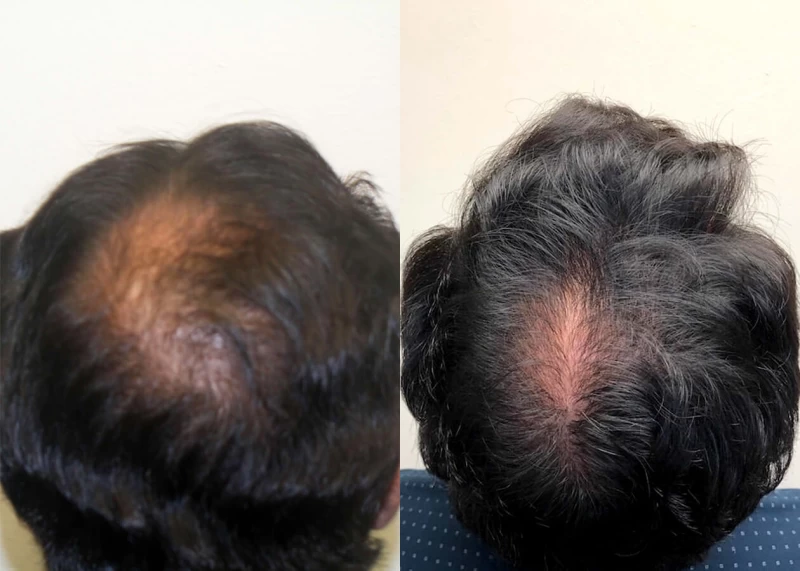 Patient p402 hair transplant before and after crown view