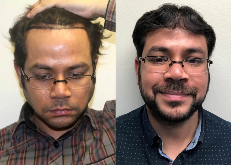 Dhruv Hair Transplant Before and After