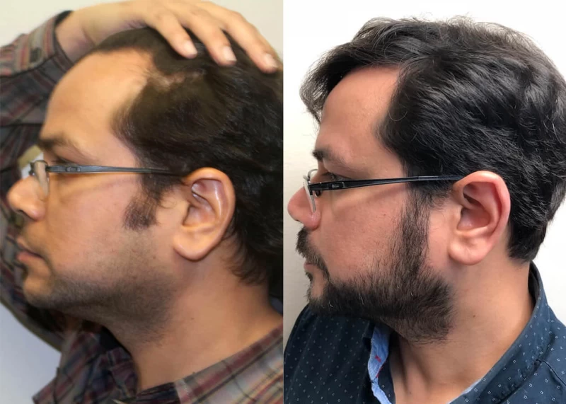 Patient p402 hair transplant before and after left view