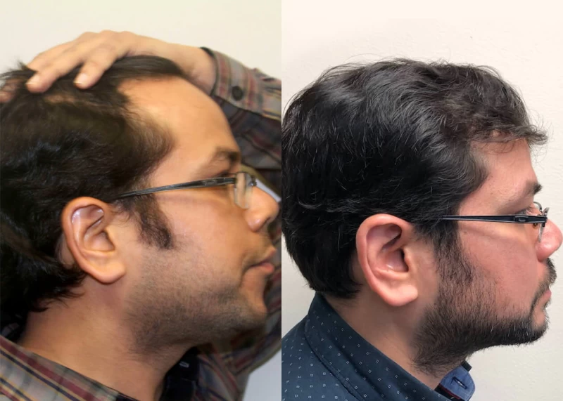 Patient p402 hair transplant before and after right view