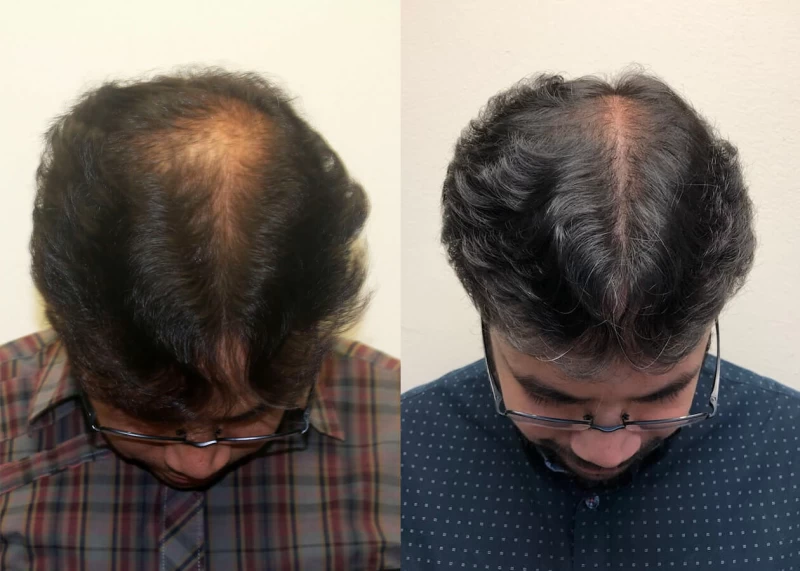 Patient p402 hair transplant before and after tilt view