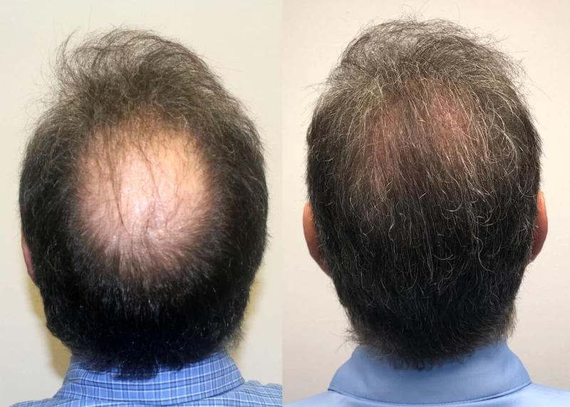 Robb Hair Transplant Before and After