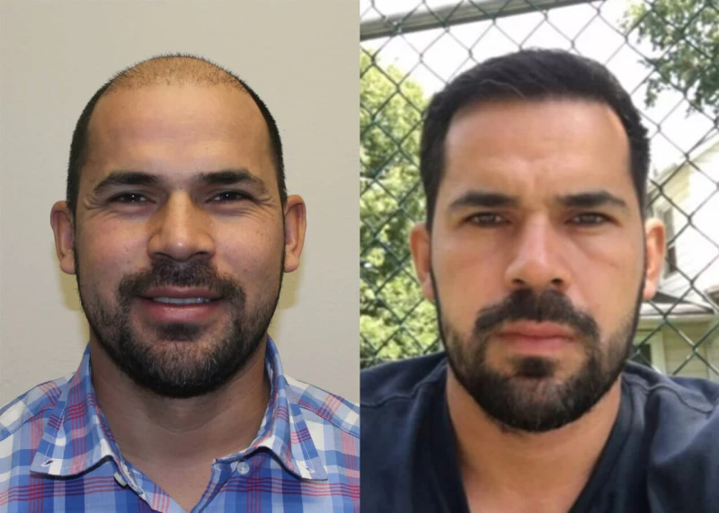Eric Hair Transplant Before and After