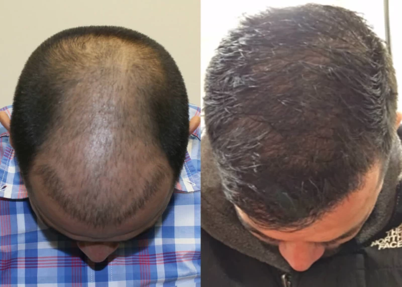 Patient p404 hair transplant before and after tilt view