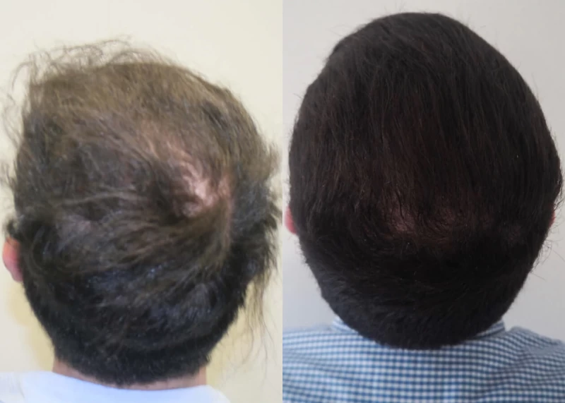 Patient p405 hair transplant before and after crown view