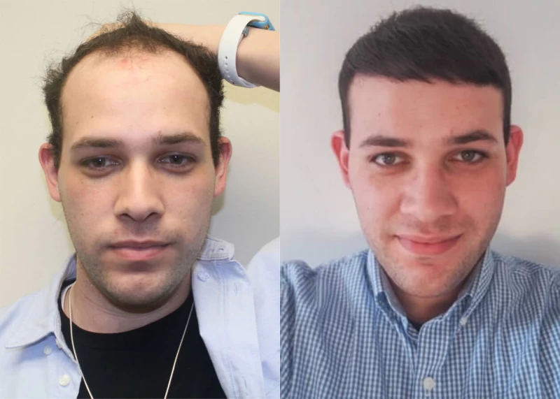 Edgar Hair Transplant Before and After