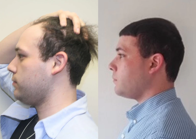 Patient p405 hair transplant before and after left view