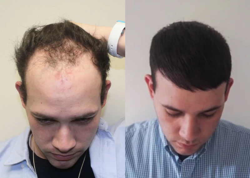 Patient p405 hair transplant before and after tilt view