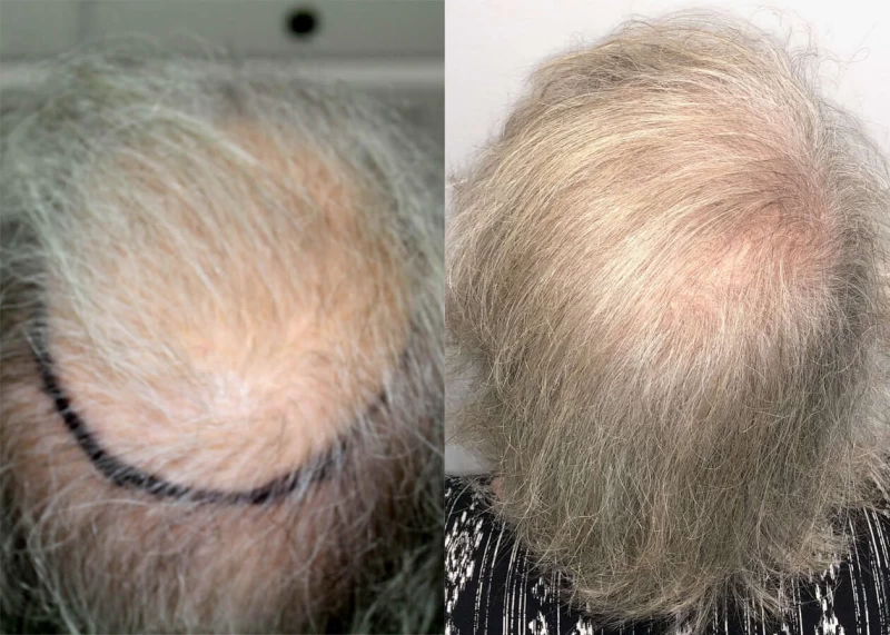 Patient p406 hair transplant before and after crown view
