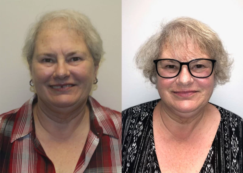 Eleanor Hair Transplant Before and After