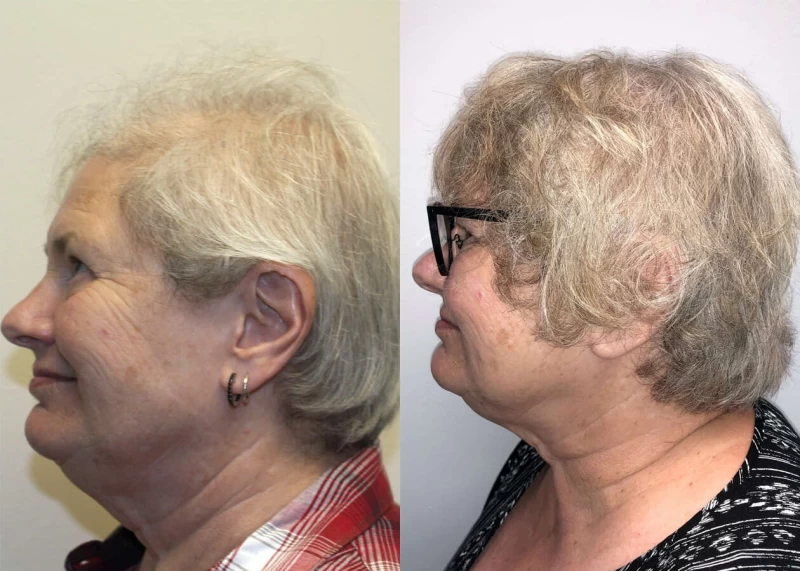 Patient p406 hair transplant before and after left view