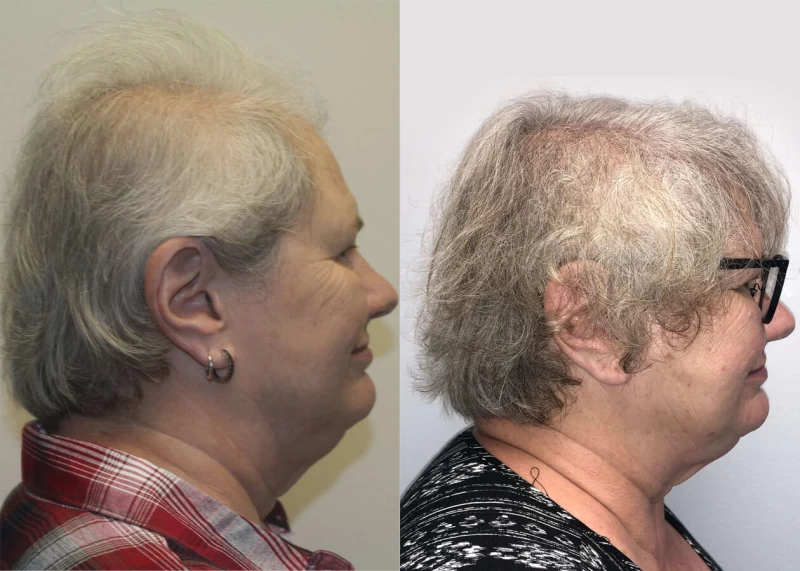 Patient p406 hair transplant before and after right view