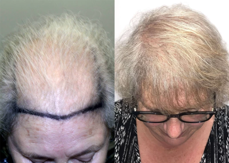 Patient p406 hair transplant before and after tilt view