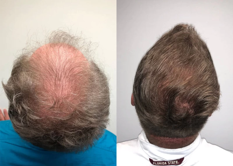 Patient p407 hair transplant before and after crown view