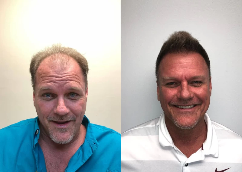 Tom  Hair Transplant Before and After