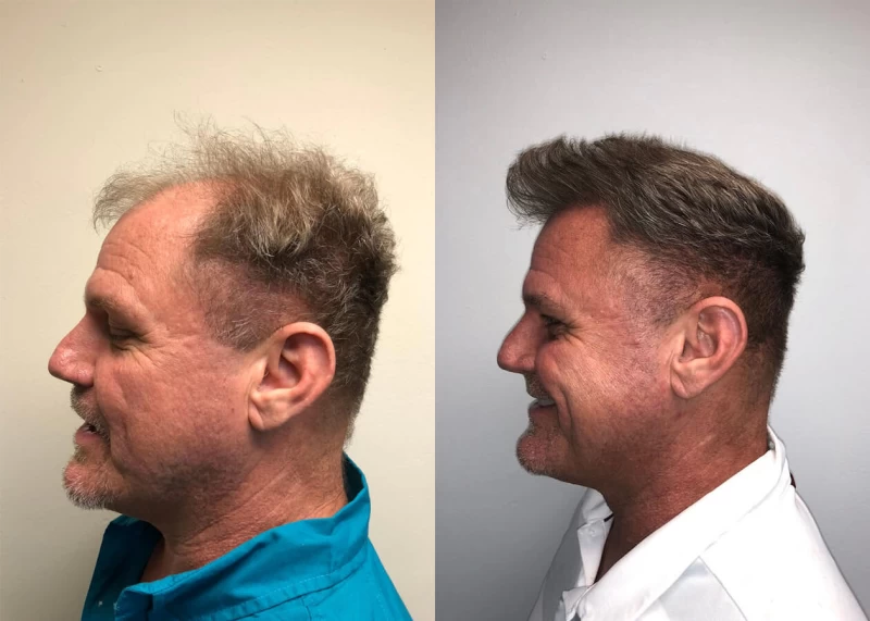 Patient p407 hair transplant before and after left view