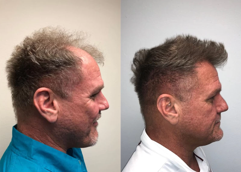 Patient p407 hair transplant before and after right view