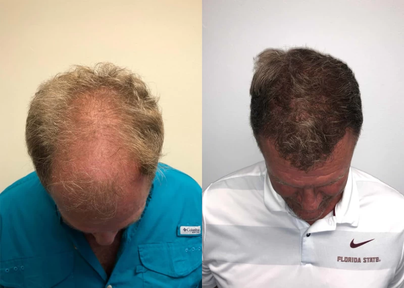 Patient p407 hair transplant before and after tilt view