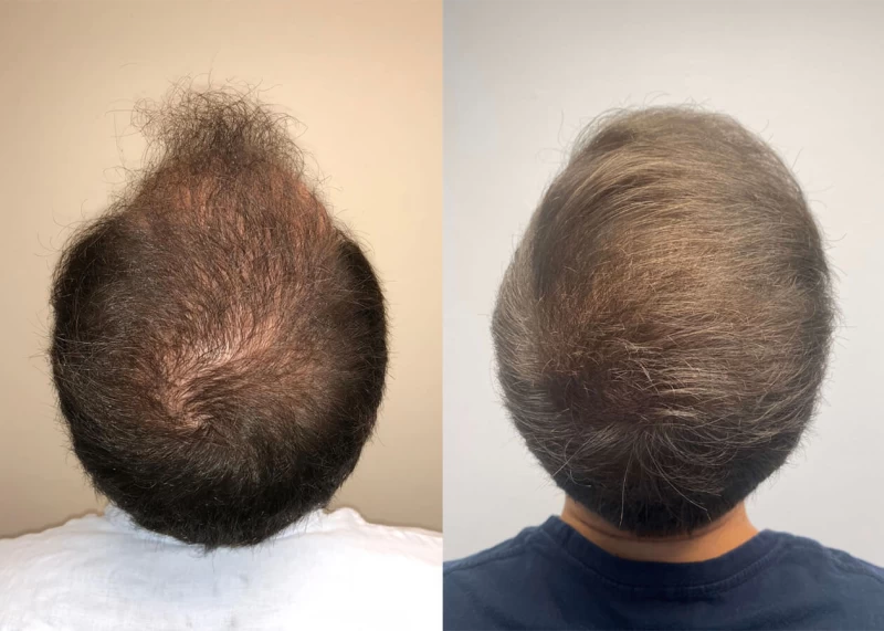 Patient p408 hair transplant before and after crown view