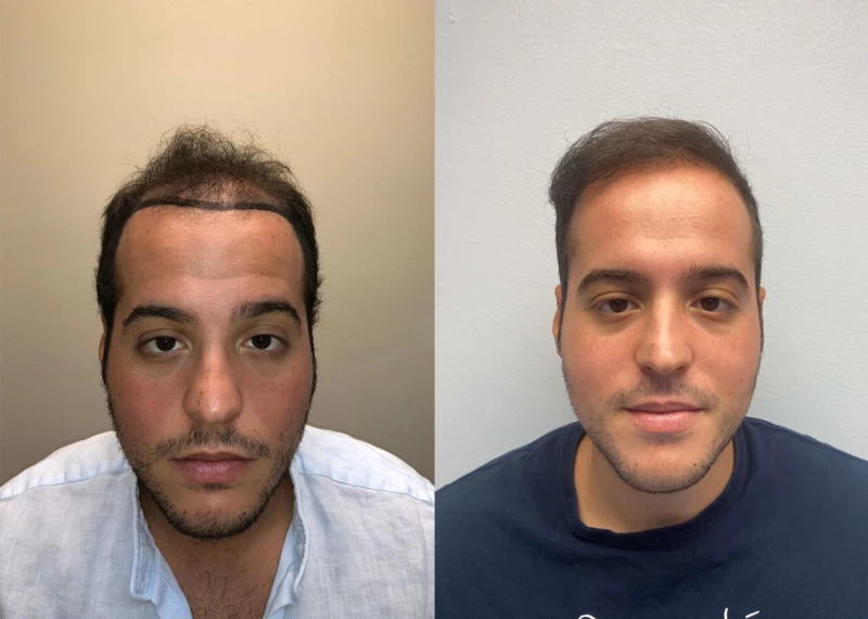 Giorgio Hair Transplant Before and After