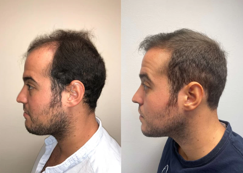 Patient p408 hair transplant before and after left view