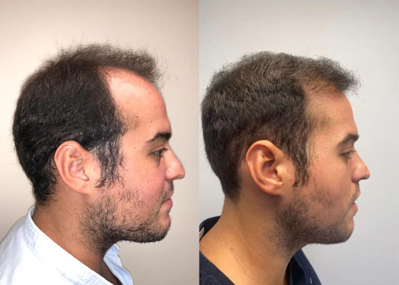 Patient p408 hair transplant before and after right view