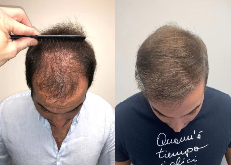 Patient p408 hair transplant before and after tilt view