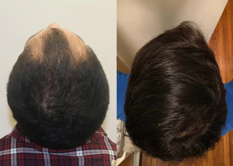 Patient p409 hair transplant before and after crown view