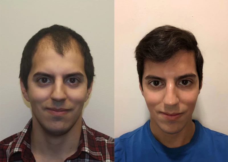 Michael Hair Transplant Before and After
