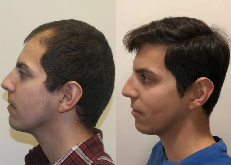Patient p409 hair transplant before and after left view