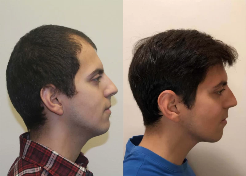 Patient p409 hair transplant before and after right view