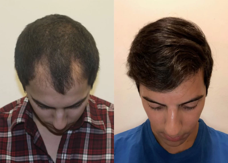 Patient p409 hair transplant before and after tilt view