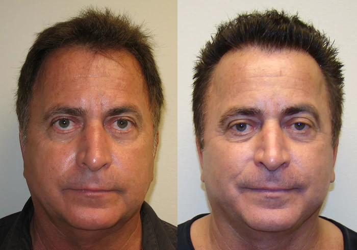 Jerry Hair Transplant Before and After
