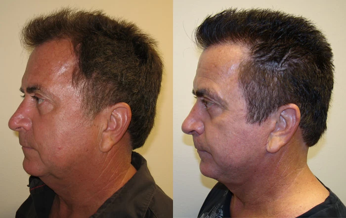 Patient p40 hair transplant before and after left view