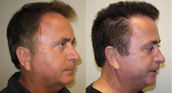 Patient p40 hair transplant before and after right view