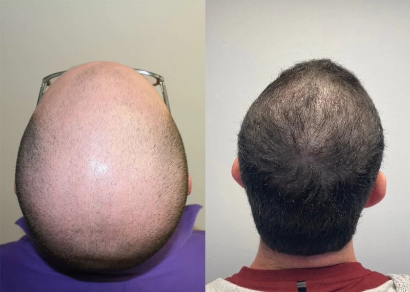 Patient p410 hair transplant before and after crown view