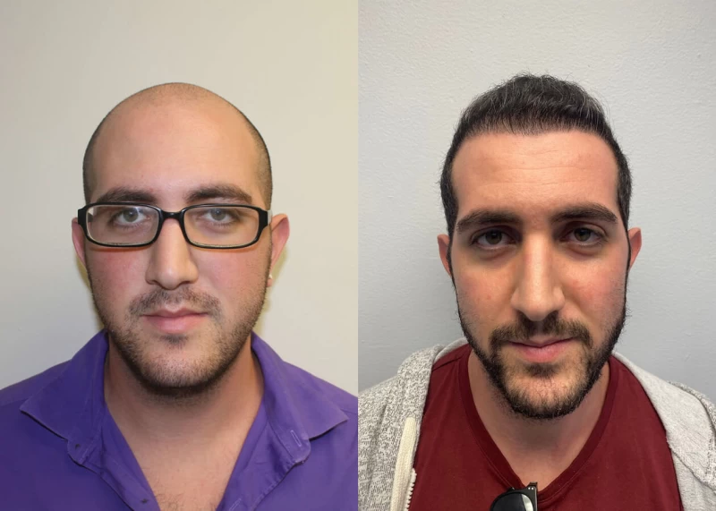Gil Hair Transplant Before and After